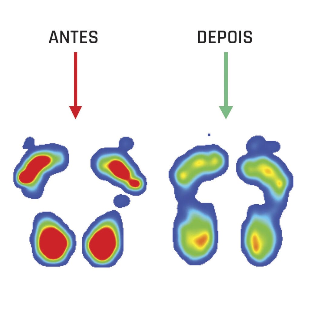Análisis de distribución de la presión plantar antes y después del uso de plantillas, mostrando una reducción de la presión en zonas críticas