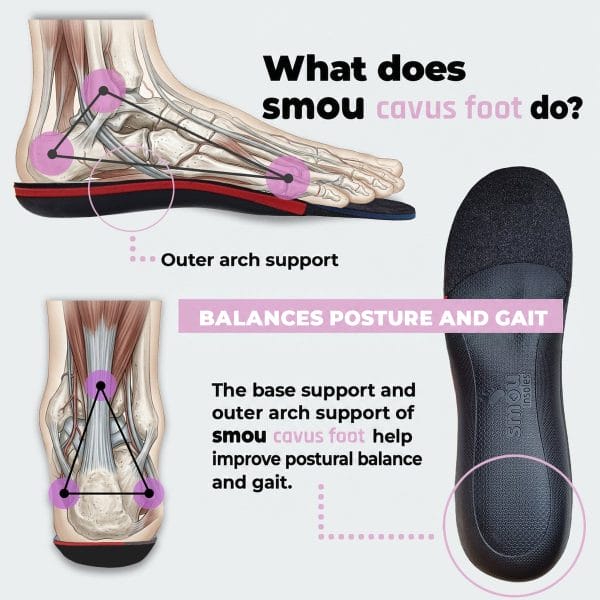 SMOU Cavus Foot · Insoles for high-arched (cavus) feet - 4